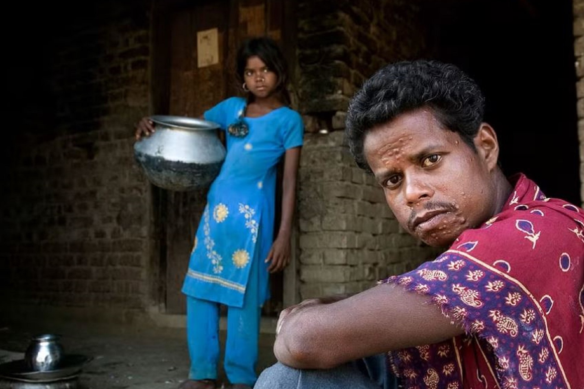 PKDL Patients in Bangladesh